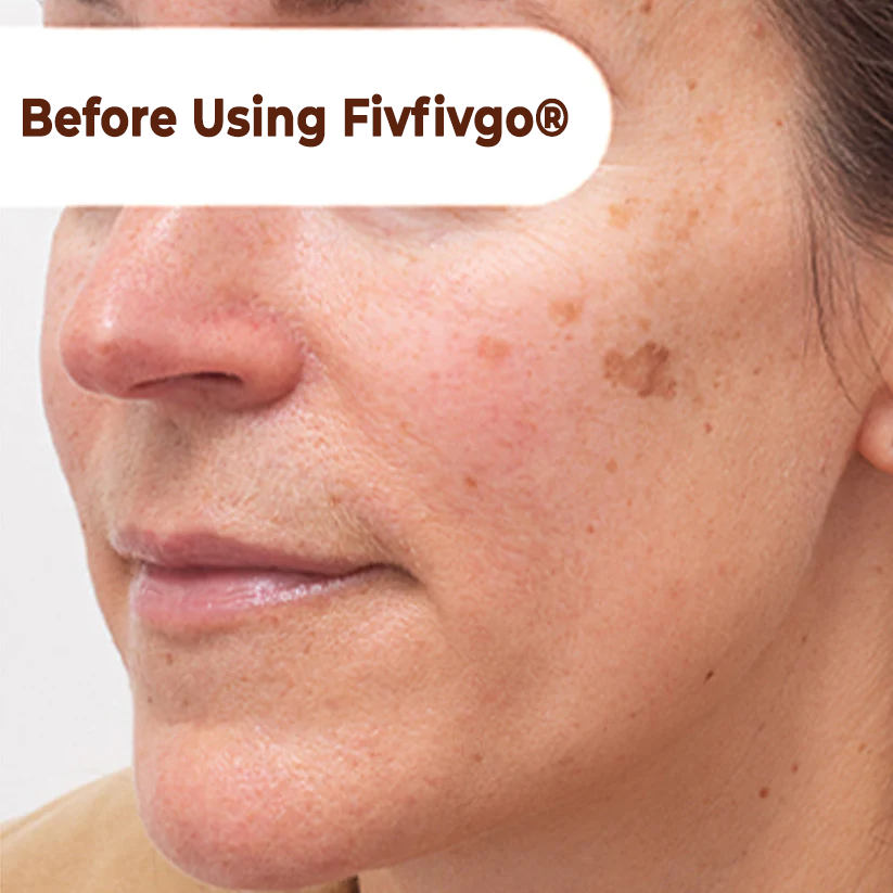 Herbal Spots Peel-Off Facial Mask
