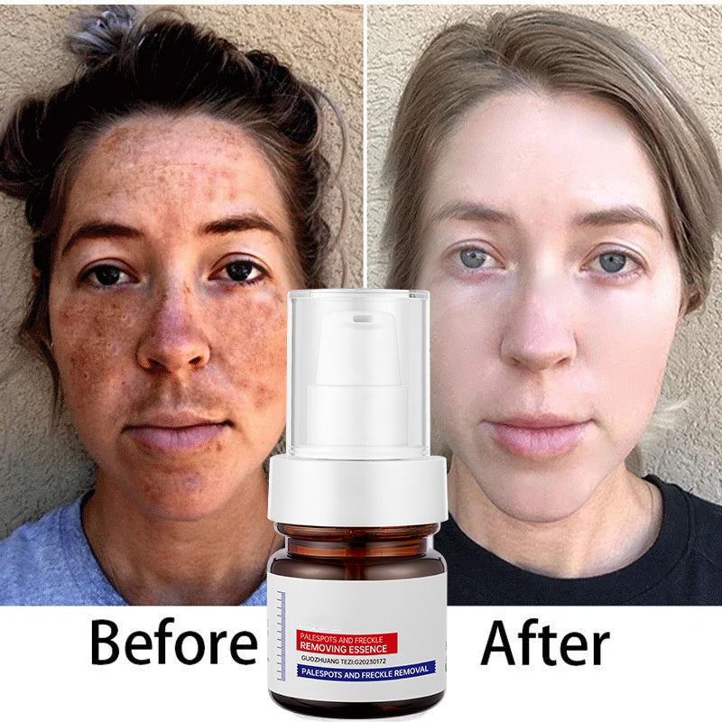 5-second brightening rescue: Dark spots disappear, blemishes fade, and skin becomes radiant! Vitamin C Whitening Freckles ESSENCE