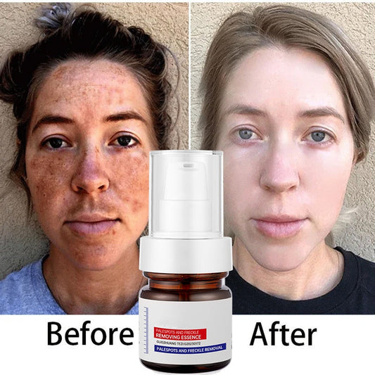 5-second brightening rescue: Dark spots disappear, blemishes fade, and skin becomes radiant! Vitamin C Whitening Freckles ESSENCE