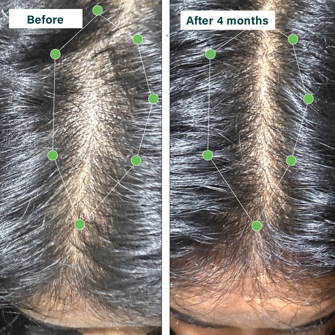 Hair Vitamins for Hair Fall & Scalp Health