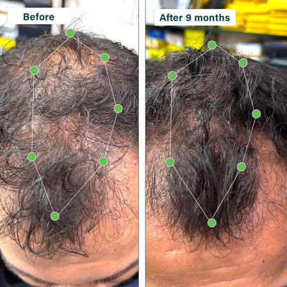 Hair Vitamins for Hair Fall & Scalp Health